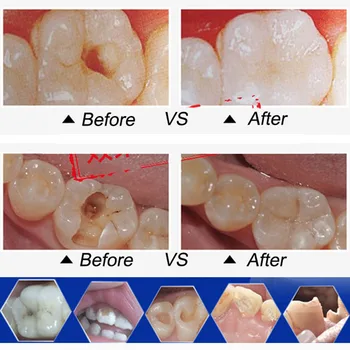 Dinte Adeziv De Umplere Dinți Cavitatea Dentara Asistenta Kit De Instrument De Material Medical Reparații Puternic Grijă Cura De Fixare Rășină De Înlocuire