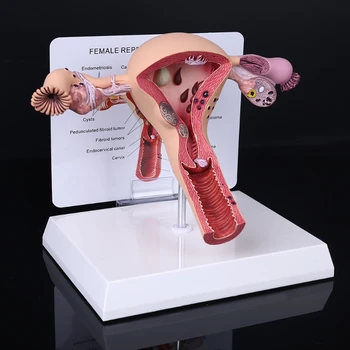 Umane De Sex Feminin Uter Ovar Boala Disecție Patologie Model De Biologie Didactice Anatomia Uterului Leziune