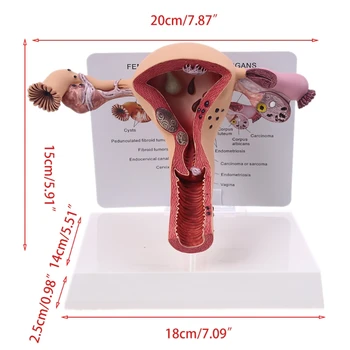 Umane De Sex Feminin Uter Ovar Boala Disecție Patologie Model De Biologie Didactice Anatomia Uterului Leziune