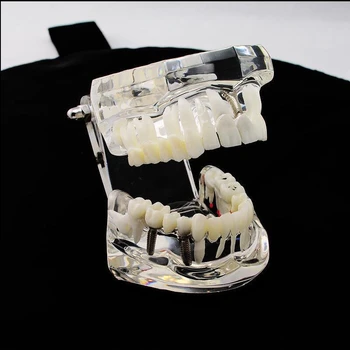 1 Buc Implant Dentar, Dintele Model Arată Restaurare Pod Știința Medicală Dentist Predare Studiu