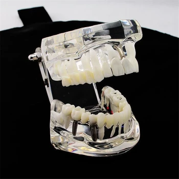 1 Buc Implant Dentar, Dintele Model Arată Restaurare Pod Știința Medicală Dentist Predare Studiu