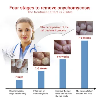 3pcs MeiYanQiong Unghiilor Fungice Tratament Ser Anti-Infecție Unghiilor Fungice Onicomicoza Paronichie Deget de la picior Ciuperca de Reparații de Îngrijire a Unghiilor