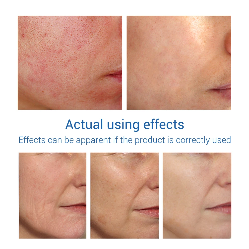 Linie de îngrijire a pielii anti-îmbătrânire pentru acnee
